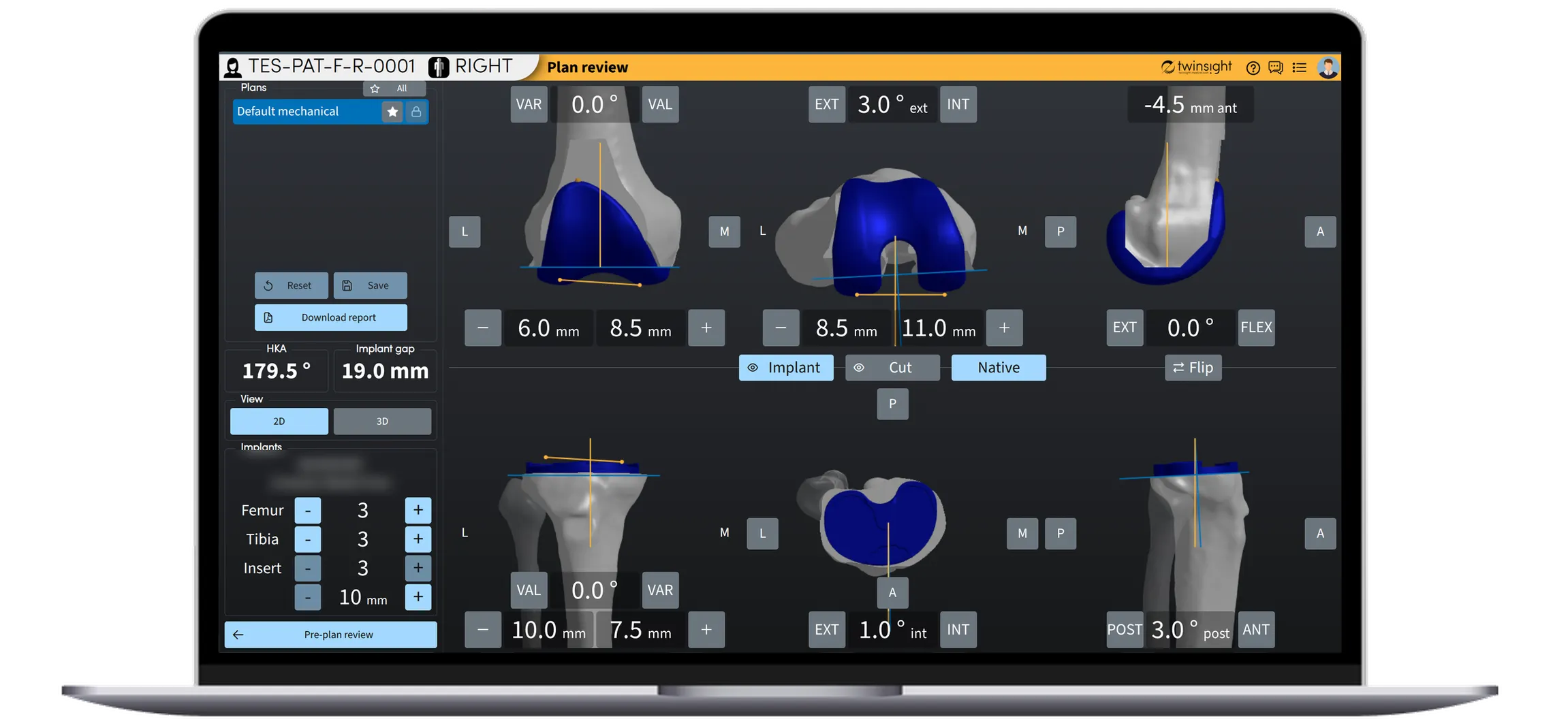 SurgiTwin 3D plan review: 2D views of the planned femoral and tibial cuts, with implant sizes and limb alignment